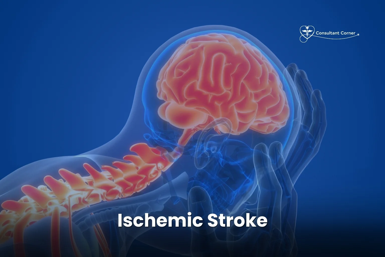 Ischemic Stroke
